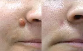 MOLE REMOVAL | SKIN TAG REMOVAL | WART REMOVAL service image